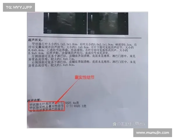 体检报告解读:结节、钙化与囊肿意味着什么?如何判断是否严重? 体检报告解读:结节、钙化与囊肿意味着什么?如何判断是否严重?